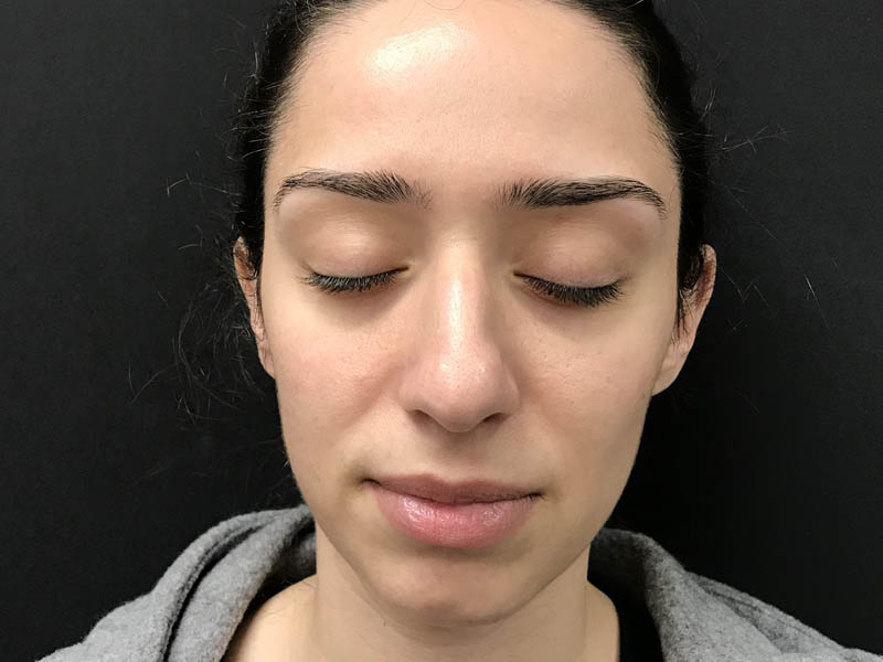 Lutronic Genius (RF Microneedling) case #48077