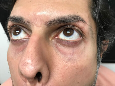 Periorbital Veins case #48083