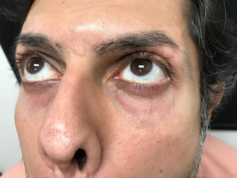 Periorbital Veins case #48083