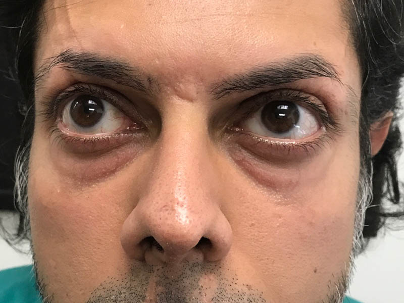 Periorbital Veins case #48083