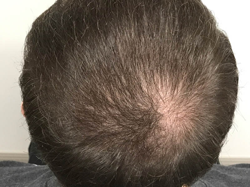 PRP Hair Restoration case #48086