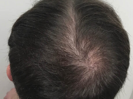 PRP Hair Restoration case #48086