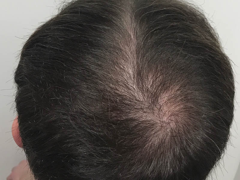 PRP Hair Restoration case #48086