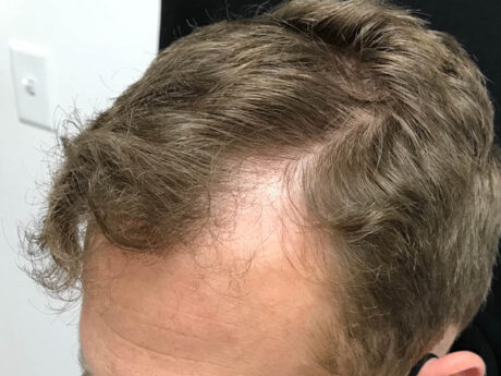 PRP Hair Restoration case #48089