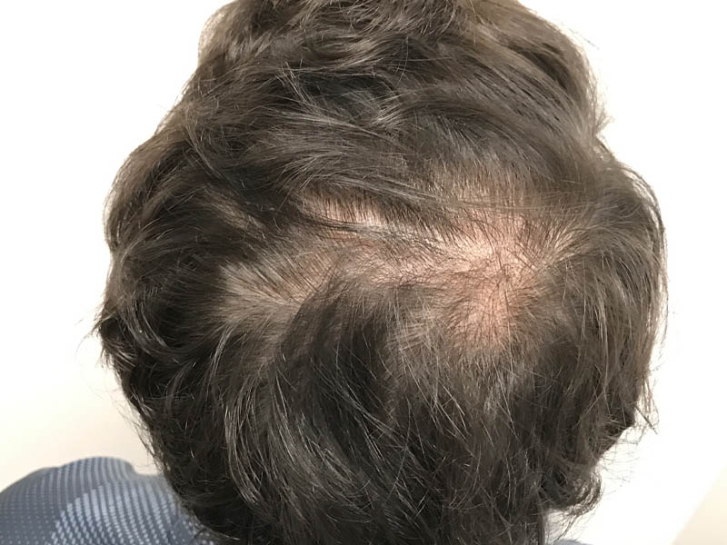 PRP Hair Restoration case #48092