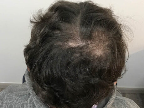 PRP Hair Restoration case #48092