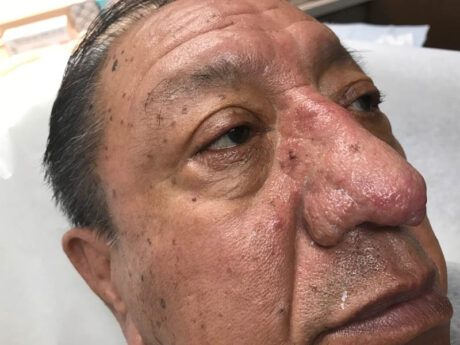 Rhinophyma case #48095