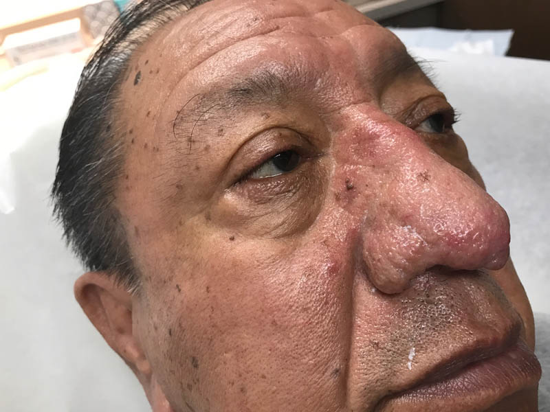 Rhinophyma case #48095