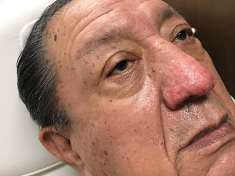 Rhinophyma case #48095