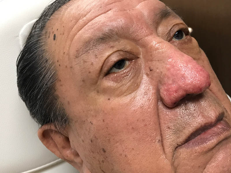 Rhinophyma case #48095