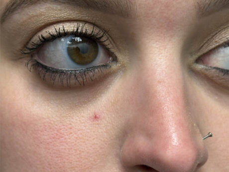 Excel V+ Vascular Laser case #48098