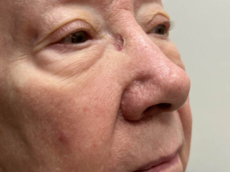 Excel V+ Vascular Laser case #48101