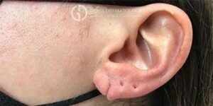 Earlobe Repair In New Jersey | Geria Dermatology