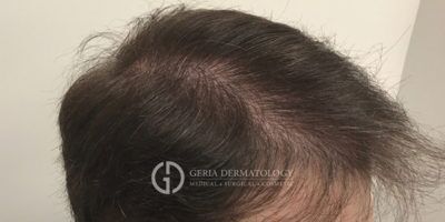 PRP Treatment In New Jersey | Geria Dermatology