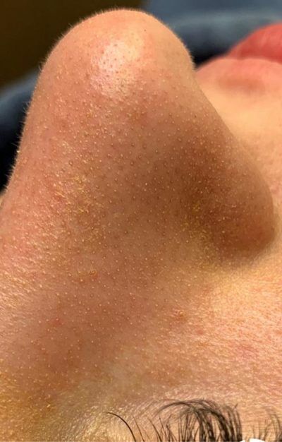 1759524797_782781781-1of2-400x626-1 HydraFacial In New Jersey | Geria Dermatology