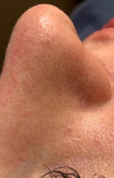 1759524815_782781781-2of2-400x626-1 HydraFacial In New Jersey | Geria Dermatology