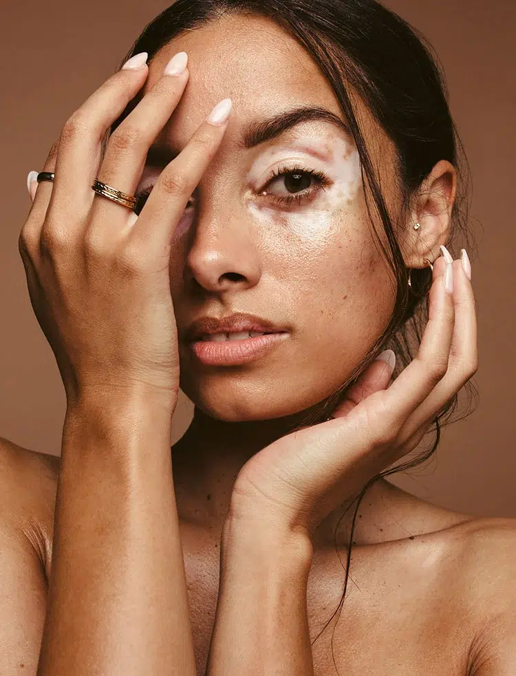 Vitiligo Treatment In New Jersey | Geria Dermatology