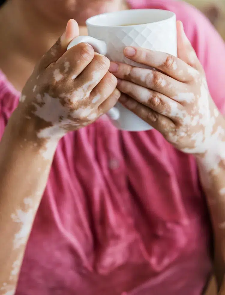 Xtrac Laser In New Jersey | Geria Dermatology