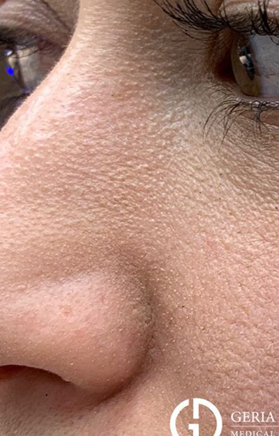 1759527132_0001-01 HydraFacial In New Jersey | Geria Dermatology