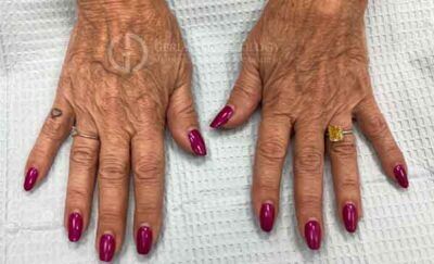 1759528356_1122024-1of4-400x243-1 Hand Fillers In New Jersey | Geria Dermatology