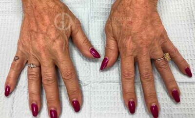 1759528368_1122024-2of4-400x243-1 Hand Fillers In New Jersey | Geria Dermatology