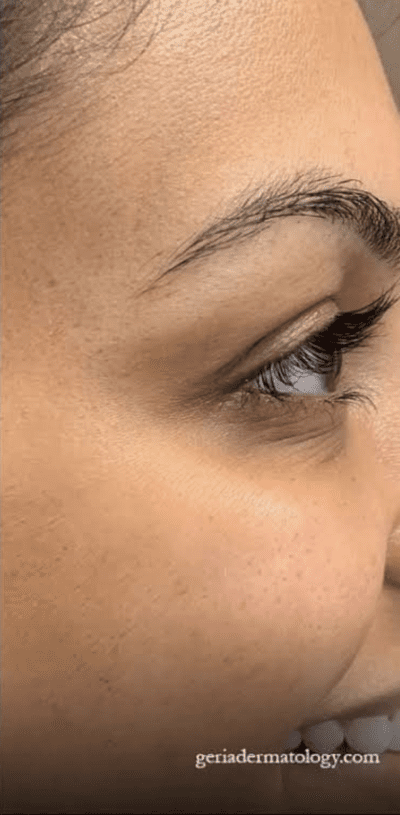 After Image: Patient Case #2914 - right-side