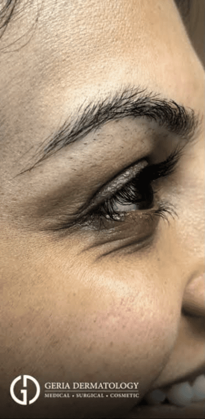 Before Image: Patient Case #2914 - right-side