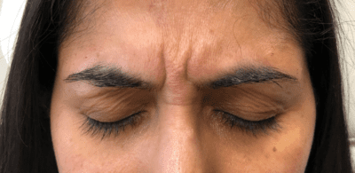 Before Image: Patient Case #2915 - front