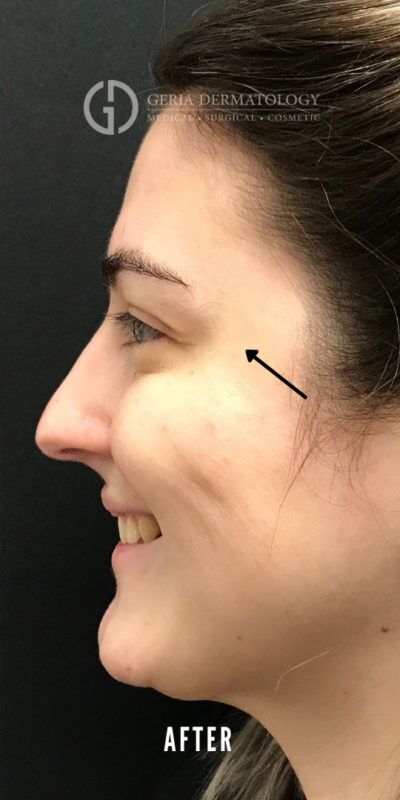After Image: Patient Case #5524 - left-side