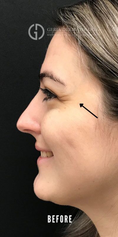Before Image: Patient Case #5524 - left-side