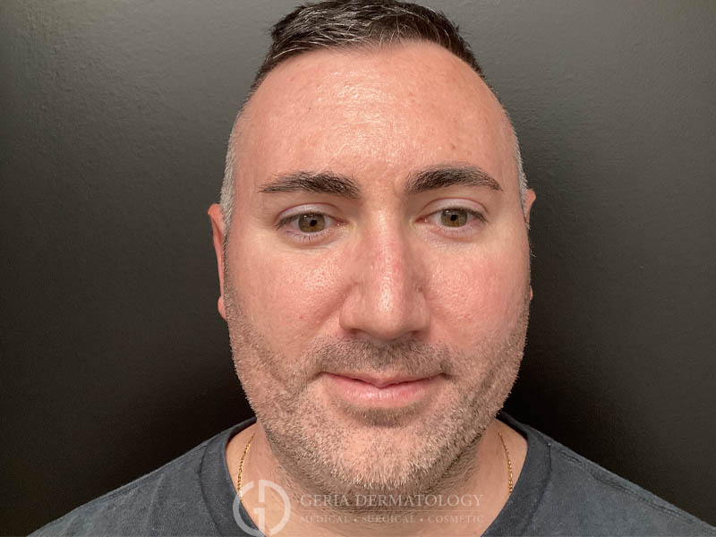 After Image: Patient Case #48047 - front