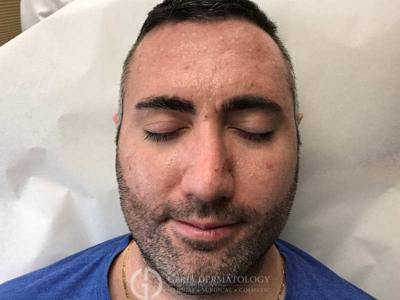 Before Image: Patient Case #48047 - front