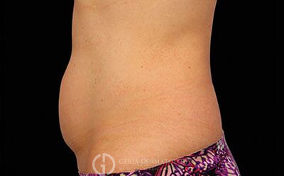 Before Image: Patient Case #2575 - left-side