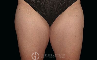 Before Image: Patient Case #2604 - front