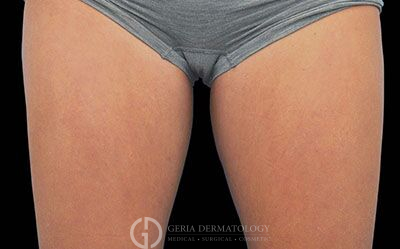 After Image: Patient Case #2630 - front