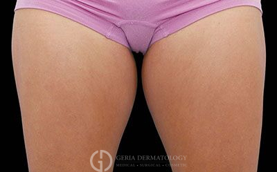 Before Image: Patient Case #2630 - front