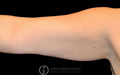 After Image: Patient Case #2732 - front