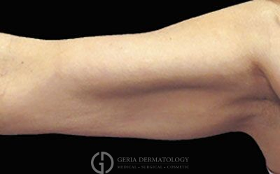 After Image: Patient Case #2760 - front