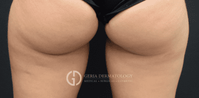 After Image: Patient Case #2926 - back