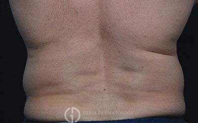 Before Image: Patient Case #2570 - back