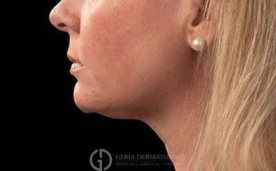 After Image: Patient Case #2571 - left-side