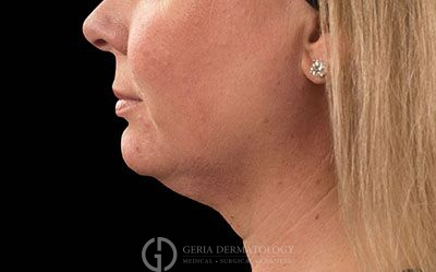 Before Image: Patient Case #2571 - left-side