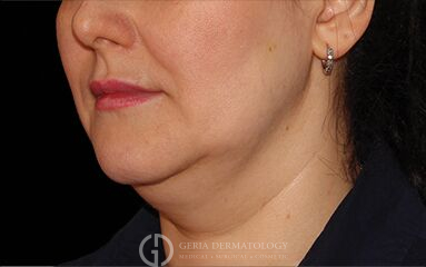 Before Image: Patient Case #273 - left-front-oblique