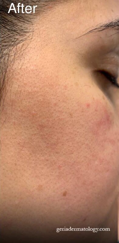 After Image: Patient Case #217 - right-side