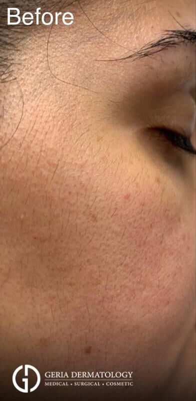 Before Image: Patient Case #217 - right-side