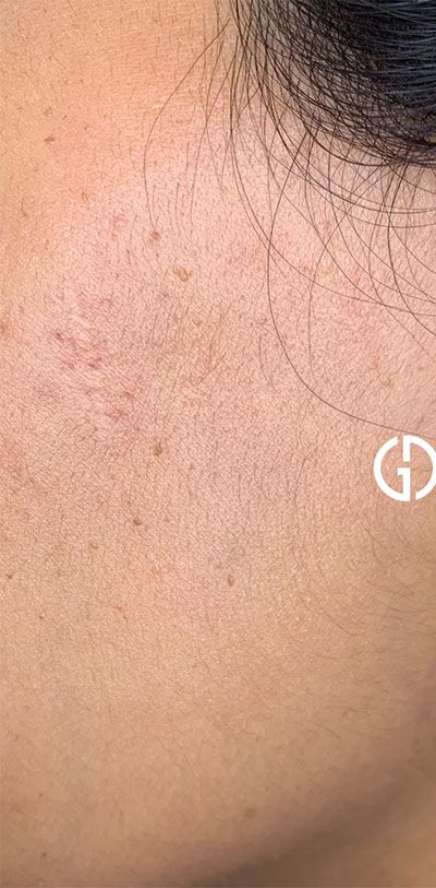 Before Image: Patient Case #365 - left-side