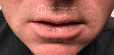 Before Image: Patient Case #3022 - front