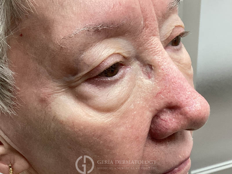 Before Image: Patient Case #48101 - right-front-oblique