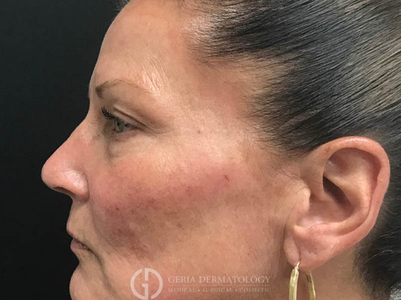 After Image: Patient Case #48041 - left-side