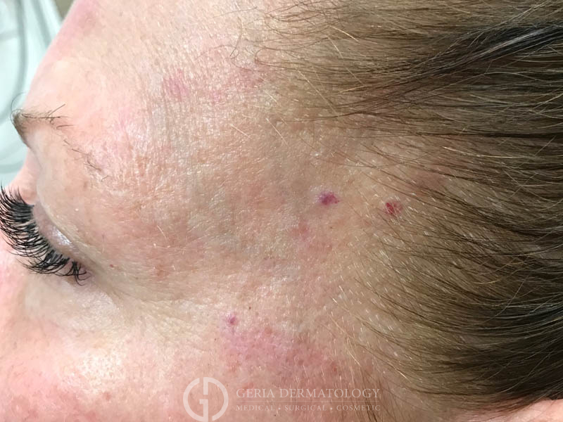 Before Image: Patient Case #48041 - left-side